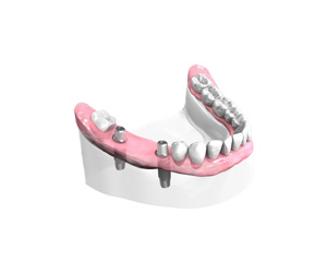 Remplacer plusieurs dents absentes ou abîmées - Dentiste Vannes