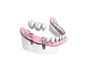 Remplacer plusieurs dents absentes ou abîmées - Dentiste Vannes