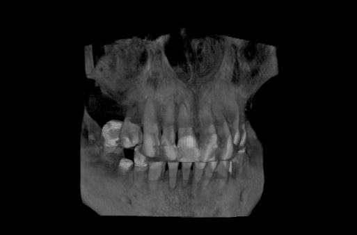 Radiographie des dents