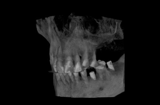 Radiographie des dents