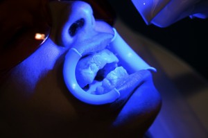 Blanchiment dentaire - Dentiste à Vannes